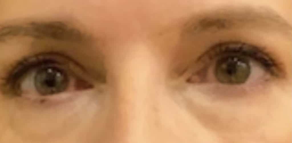 After Image: Blepharoplasty - front