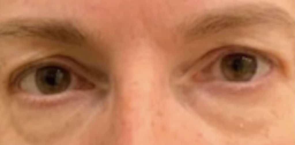 Before Image: Blepharoplasty - front
