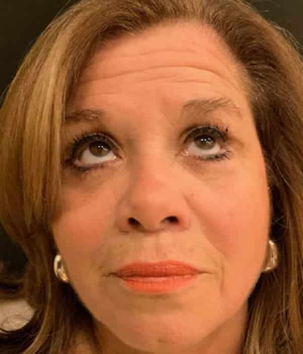 After Image: Blepharoplasty - front