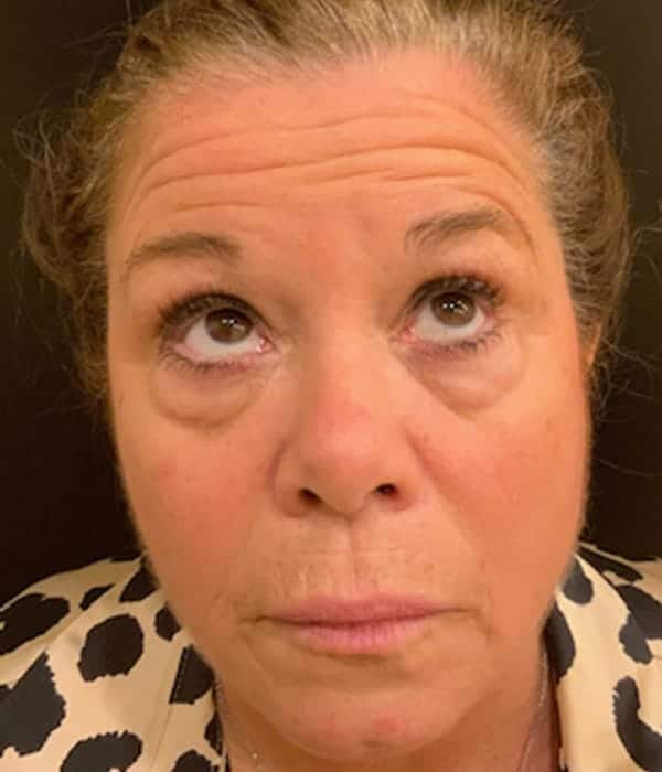 Before Image: Blepharoplasty - front