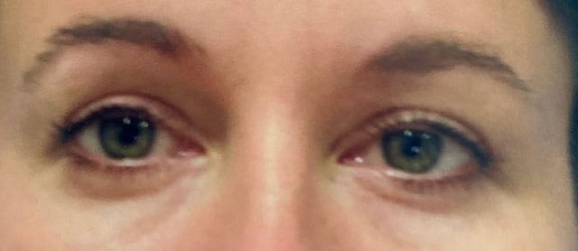 After Image: Blepharoplasty - front