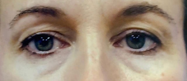 Before Image: Blepharoplasty - front