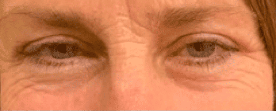 After Image: Blepharoplasty - front