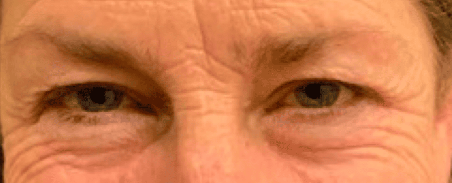 Before Image: Blepharoplasty - front