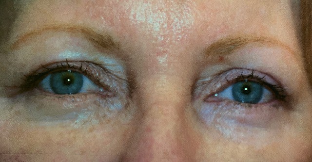 After Image: Blepharoplasty - front