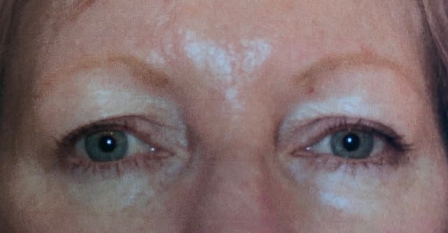 Before Image: Blepharoplasty - front