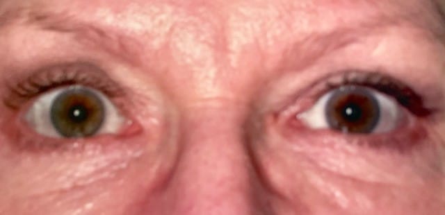 After Image: Blepharoplasty - front