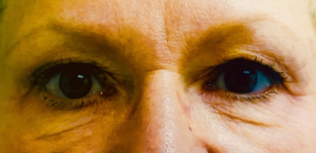 Before Image: Blepharoplasty - front