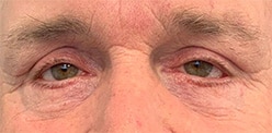 After Image: Blepharoplasty - front