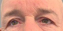 Before Image: Blepharoplasty - front