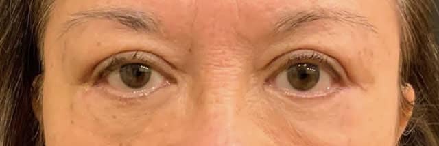 After Image: Blepharoplasty - front