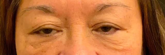 Before Image: Blepharoplasty - front