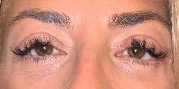After Image: Blepharoplasty - front