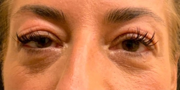 Before Image: Blepharoplasty - front