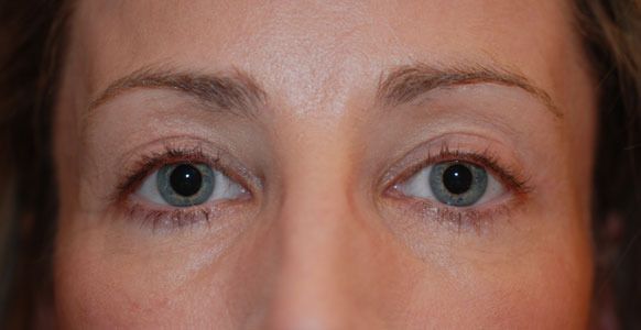 After Image: Blepharoplasty - front