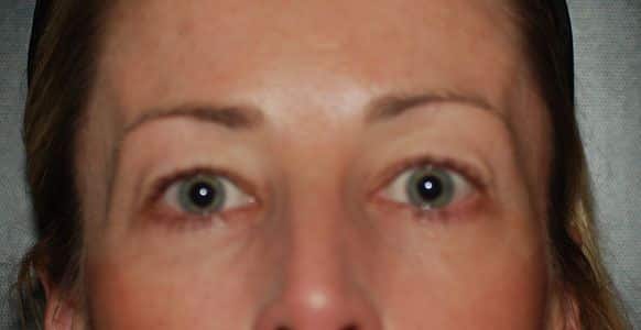 Before Image: Blepharoplasty - front
