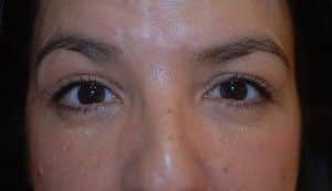 After Image: Blepharoplasty - front
