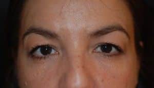 Before Image: Blepharoplasty - front