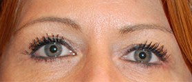 After Image: Blepharoplasty - front