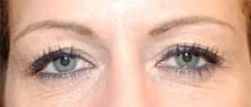 Before Image: Blepharoplasty - front