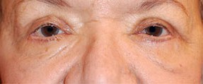 After Image: Blepharoplasty - front