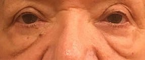 Before Image: Blepharoplasty - front