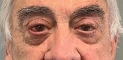 After Image: Blepharoplasty - front