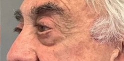 After Image: Blepharoplasty - left-front-oblique