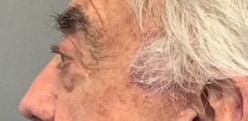 After Image: Blepharoplasty - left-side