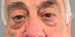 Before Image: Blepharoplasty - front