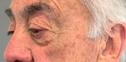 Before Image: Blepharoplasty - left-front-oblique