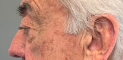 Before Image: Blepharoplasty - left-side