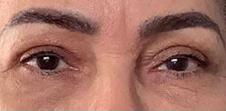After Image: Blepharoplasty - front