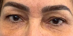 Before Image: Blepharoplasty - front
