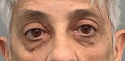 After Image: Blepharoplasty - front