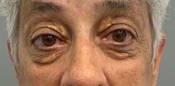 Before Image: Blepharoplasty - front