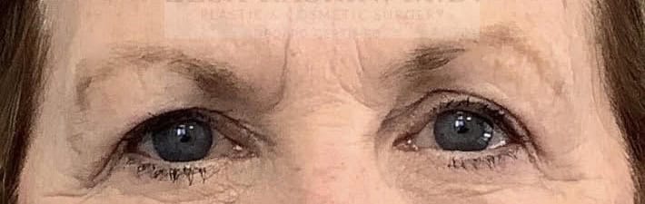 After Image: Blepharoplasty - front