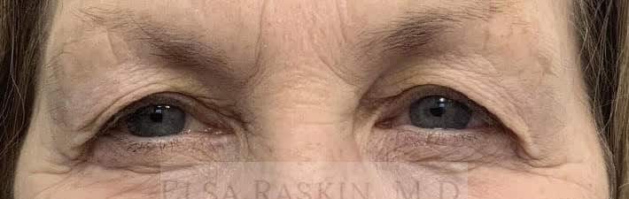 Before Image: Blepharoplasty - front