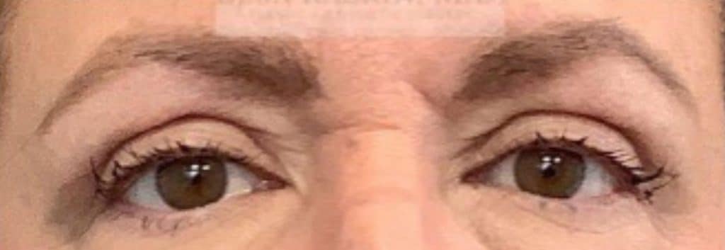 After Image: Blepharoplasty - front
