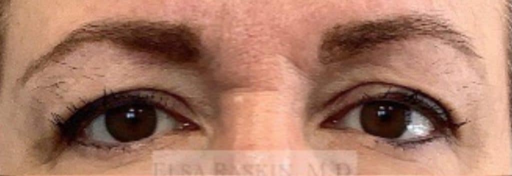 Before Image: Blepharoplasty - front