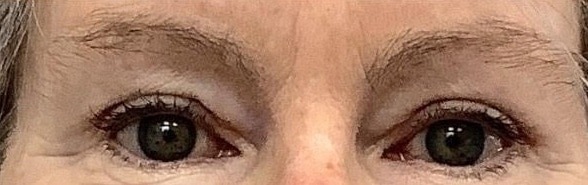 After Image: Blepharoplasty - front