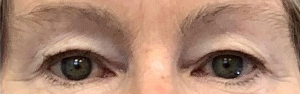 Before Image: Blepharoplasty - front