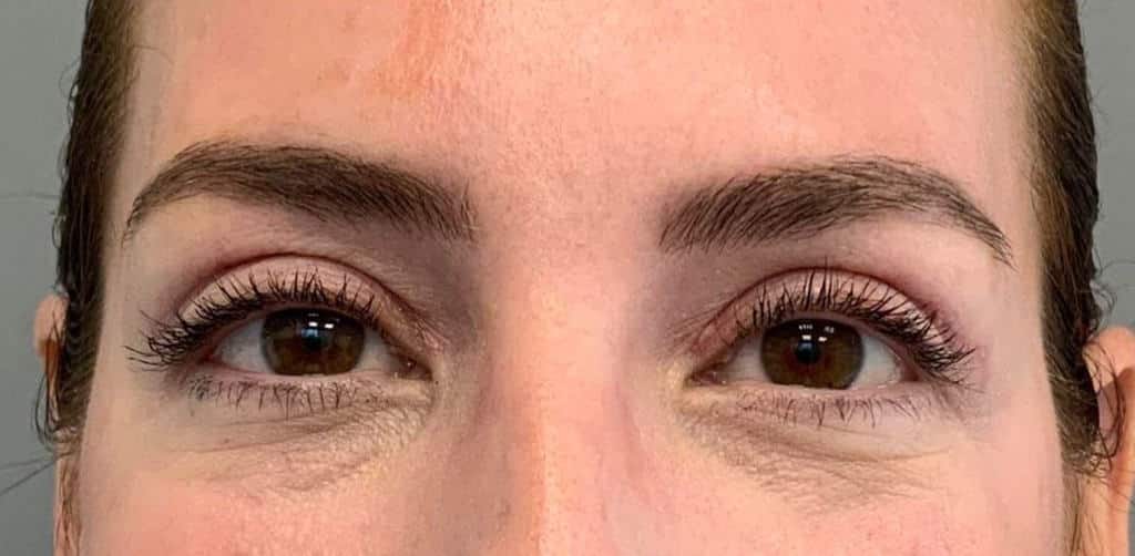 After Image: Blepharoplasty - front