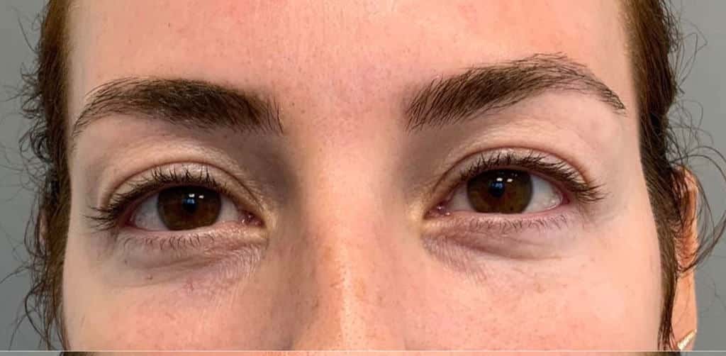 Before Image: Blepharoplasty - front