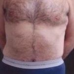 After Image: Body Lift - front