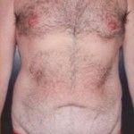 Before Image: Body Lift - front