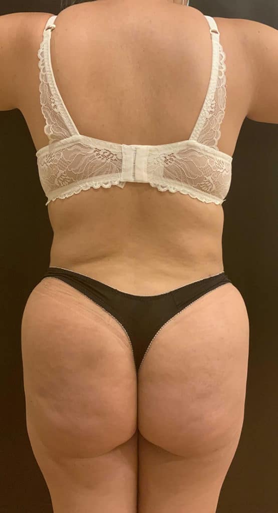 After Image: Brazilian Butt Lift - back