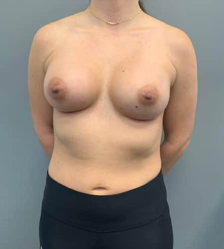 After Image: Breast Augmentation - front