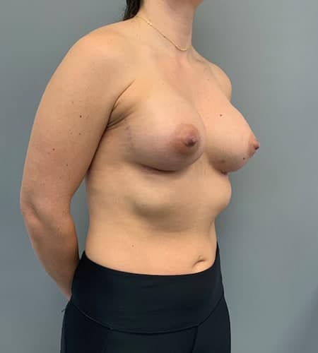 After Image: Breast Augmentation - right-front-oblique