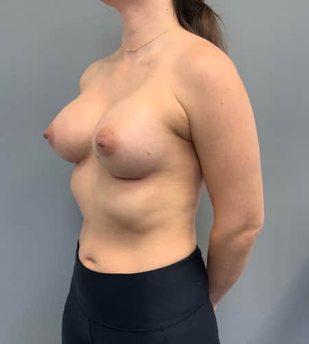 After Image: Breast Augmentation - left-front-oblique
